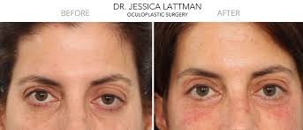 While some changes ― like haircuts or brow tints ― don't require much research, others can seem a little more daunting. Endoscopic Browlift Expert Nyc Droopy Eyebrows New York And Manhattan Nyc