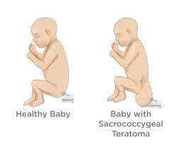 Check spelling or type a new query. Sacrococcygeal Teratoma Sct Diagnosis Treatment Ssm Health