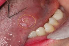 Image result for white cancer on tongue)
