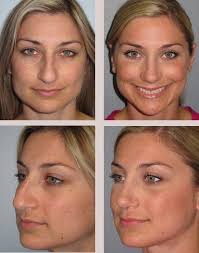 Nose Surgery Rhinoplasty Before And After Photos Nose Surgery Rhinoplasty Nose Surgery Rhinoplasty Nose Jobs