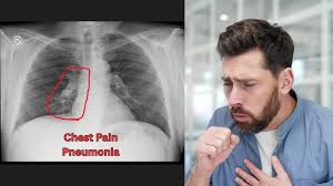 Image result for Chest XRay