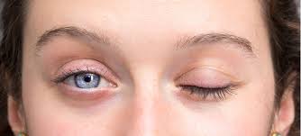 In the past, bell's palsy was thought to be a highly uncommon occurrence. Bell S Palsy How It Affects The Eye Feel Good Contacts Uk