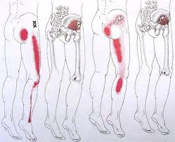 Pin On Triggerpoint Massage