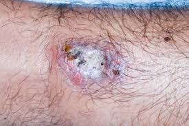 Skin cancer is the most common type of cancer in the u.s. Pyoderma Gangrenosum Nhs