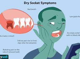 Applying pressure is the only way to stop bleeding. What Is A Dry Socket
