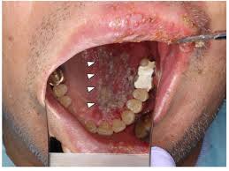 Image result for Oral herpes roof of mouth