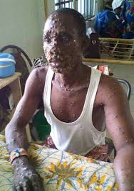 Monkeypox is taking a short break. Monkeypox Is Real These Are Things You Should Know About Monkeypox Steemit