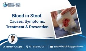 Image result for Blood in stool