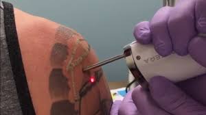 Our pico tattoo removal laser is the best laser for most tattoos and skin types. The Best Laser Tattoo Removal In Cleveland Ohio At Enlighten Aesthetic Of Cleveland Youtube
