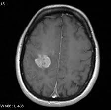 Radiology Quiz 10546 Radiopaedia Org I can only highly recommended it! radiopaedia
