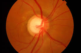 Image result for Glaucoma