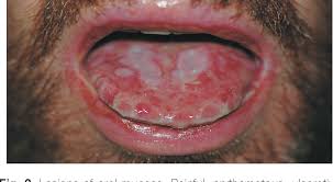 Shavit gavish september 25, 2011 skin, hair and nails. Pdf Stevens Johnson Syndrome And Abuse Of Anabolic Steroids Semantic Scholar