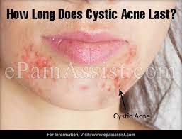 Nodules have a similar structure to papules, but this type of pimple is much larger and a bit more painful. How Long Does Cystic Acne Last Can Cystic Acne Go Away On Its Own