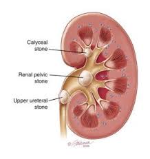 Kidney Stone Formation Is Due To The Accumulation Of Minerals Calcium Or Most Likely Salts Kidney Stones Remedy Kidney Stones Symptoms Chronic Kidney Disease