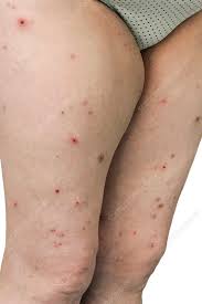 Image result for flea bites