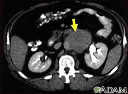 Studies have shown that ct can be effective in both colorectal cancer screening (including screening for large polyps) and lung cancer screening. Abdominal Ct Scan Information Mount Sinai New York