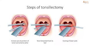 Image result for Tonsillectomy