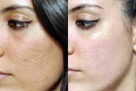 Check spelling or type a new query. Helpful Tips To Get The Best Results With Micro Needling Serayu Beauty