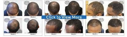 Black hair care products specially formulated to address dry, breaking, damaged and unhealthy hair. Do Your Hair Loss Treatments Work On Black Men