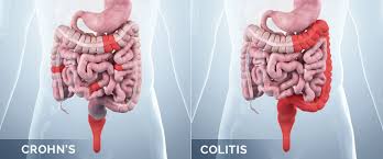 Crohn S Disease And Ulcerative Colitis Central Melbourne Specialists