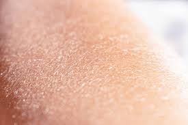 Image result for Dry Skin