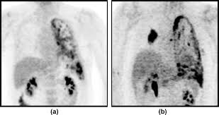 Chest recent advances in chest medicine malignant pleural mesothelioma an update on immunohistochemical diagnosis of epithelioid mesothelioma: The Role Of Imaging In Malignant Pleural Mesothelioma An Update After The 2018 Bts Guidelines Clinical Radiology