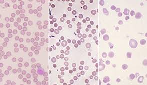 Image result for Anemia angolensis