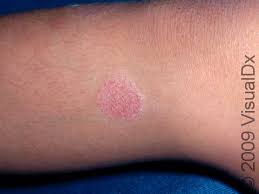 Image result for Eczema nummulare