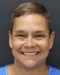 🦷✨ Before & After Transformation! These radiographs tell an incredible  story — from missing and failing teeth to a fully restored smile with an  All-on-X implant-supported denture. The difference isn't just in