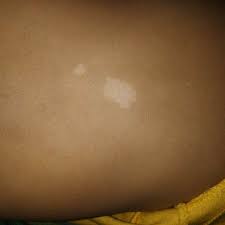 A vitamin d deficiency can also result in the formation of white spots, as low vitamin d levels are associated with psoriasis, a. Good Evening Docs My Baby Is 8 Months 24 Days Old She Is Having White Spots On Body I M Applying Calamine Light Liquid Paraffin Lotion A Day But White Spots Not Vanish Plz