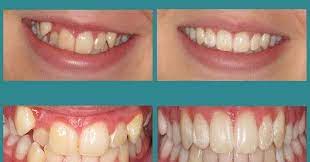 Take a free assessment to see if you are eligible. Dental Braces Malaysia Review And Cost 2021 2020