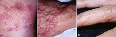 Tips on how to get rid of cactus mealybug. Plant Induced Dermatitis Anesthesia Key