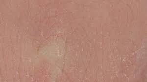 Kulit kering seringkali membuat tidak nyaman seperti kulit menjadi terasa gatal, dan ketika terus menerus digaruk muncul ruam kemerahan dan luka pada kulit. Mengenal Biang Keladi Kulit Kering Dan Gatal