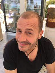 haartransplantation forum hairmedic hairmedic transplantiert willi herren