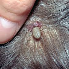 Image result for infected tick bite