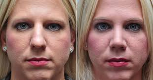 This Houston Area Rhinoplasty Patient Desired Rhinoplasty For A Bulbous Tip More Slim Nose And Improved Profile Rhinoplasty Bulbous Nose Tips