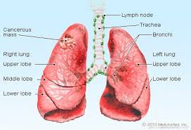 This test is more likely to help find cancers that start in the major airways of the lung, such as squamous cell lung cancers. Lung Cancer Sclc Nsclc Symptoms Causes Survival Rates Types