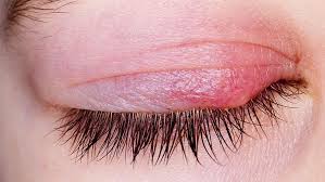 Meist sind staphylokokken für das gerstenkorn verantwortlich: Lidrandentzundung Blepharitis Focus Arztsuche