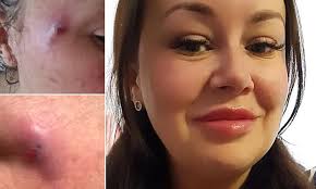 Mother-of-two's face erupted in giant boils after £60 anti-wrinkle jabs and  left her needing an HIV test after she claimed beautician had used a 'dirty  needle'