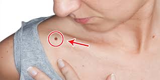 Skin cancer is one of the most common types of cancer. Signs And Symptoms Of Skin Cancer