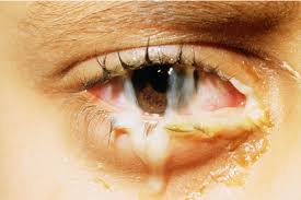 Image result for Conjunctivitis Resources
