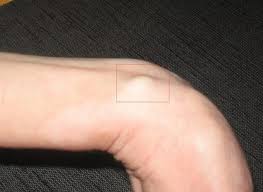 Профилактика ухудшений общего состояния здоровья. Uplotnenie Pod Kozhej V Vide Sharika Foto Prichiny Kak Lechit