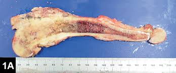 The cause of osteosarcoma or bone cancer in dogs is currently unknown. Canine Osteosarcoma Part 1 Clinician S Brief