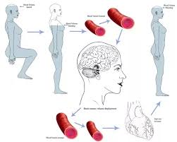 It just means that when you shift from lying down or sitting to standing, your blood pressure drops and you momentarily feel a little woozy. Why Does My Vision Gradually Go Black With Sudden Dizziness For A Few Seconds When I Suddenly Stand Up Is It Normal Quora
