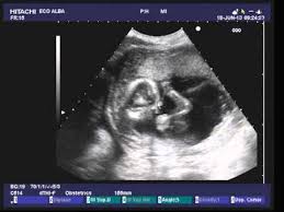 16 settimane di gravidanza è il periodo di sviluppo attivo del sistema nervoso, delle ossa e dei muscoli. Ecografia 17 Settimana Di Gravidanza Figlio Maschio Youtube