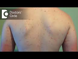 Image result for sweat rash on back