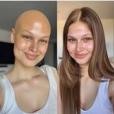 Acabei de terminar a quimioterapia. Adoraria receber mensagens de saúde e  votos de longa vida para vocês , pena que logo a foto isso aconteceu comigo  e eu não acreditei