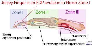 About the finger flexor tendon anatomy model (left index) is an educational model created by janson to demonstrate the action of finger fdp & fds flexor tendons gliding through the a2 and a4 pulleys. Jersey Finger Hand Orthobullets