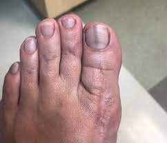 It may resemble a plantar's wart or a foot ulcer, and it may feel scaly. Diagnosing And Treating Squamous Cell Carcinoma Of The Nail Bed Podiatry Today