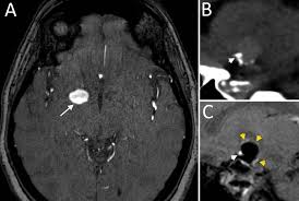 Order to estimate the thrombus of. Vessel Wall Enhancement Of Intracranial Aneurysms Fact Or Artifact In Neurosurgical Focus Volume 47 Issue 1 2019